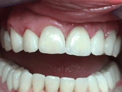 In the front region are veneers and there are zircon-ceramic bridges in the rear region.